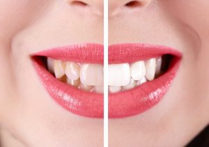 Nu-Radiance Teeth Whitening system