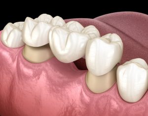 Picture of a dental bridges being placed over the molar and premolar teeth.