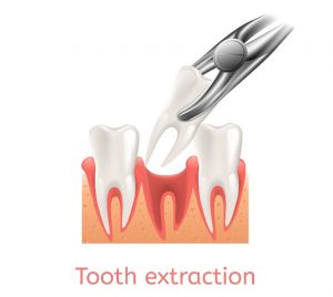 An image displaying the process of extracting a tooth