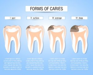 An image displaying the forming of tooth caries